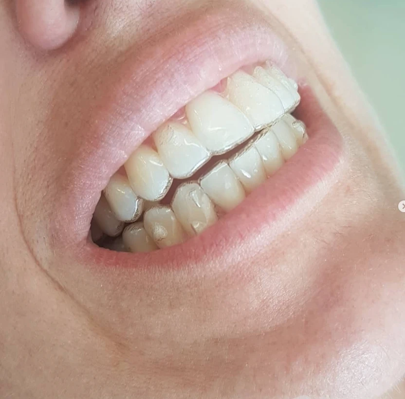 Alinhador transparente em uso