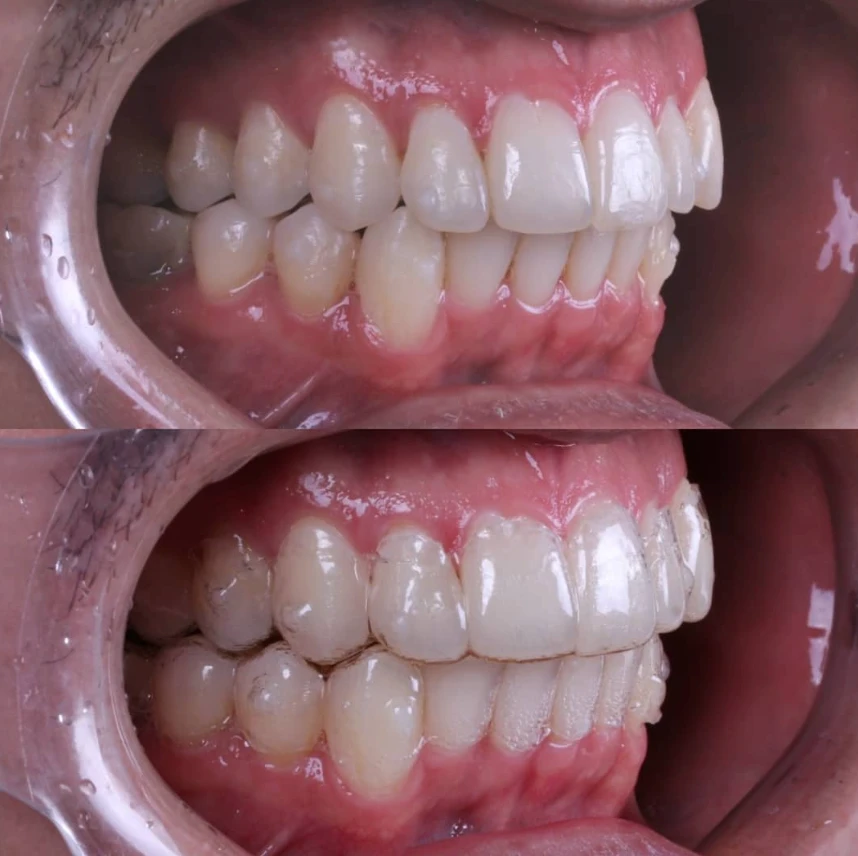 Sorriso sem e com alinhadores, vista lateral