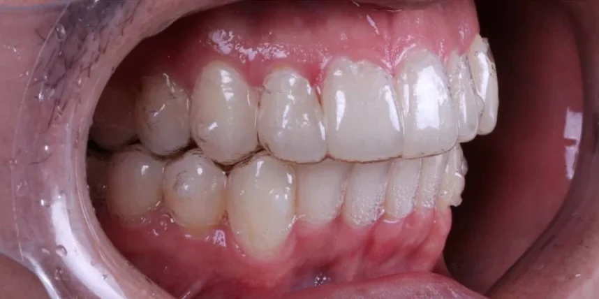 Sorriso com alinhador transparente encaixado
