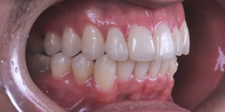 Mesmo sorriso sem alinhador