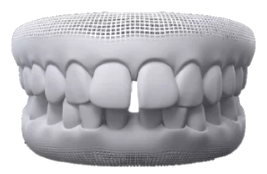 Ilustração de diastema