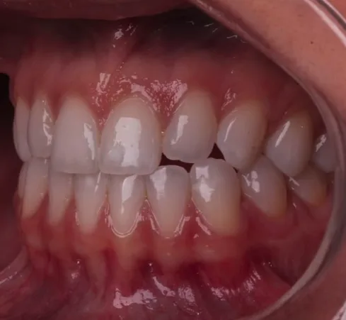 Sorriso em tratamento ortodôntico, vista frontal